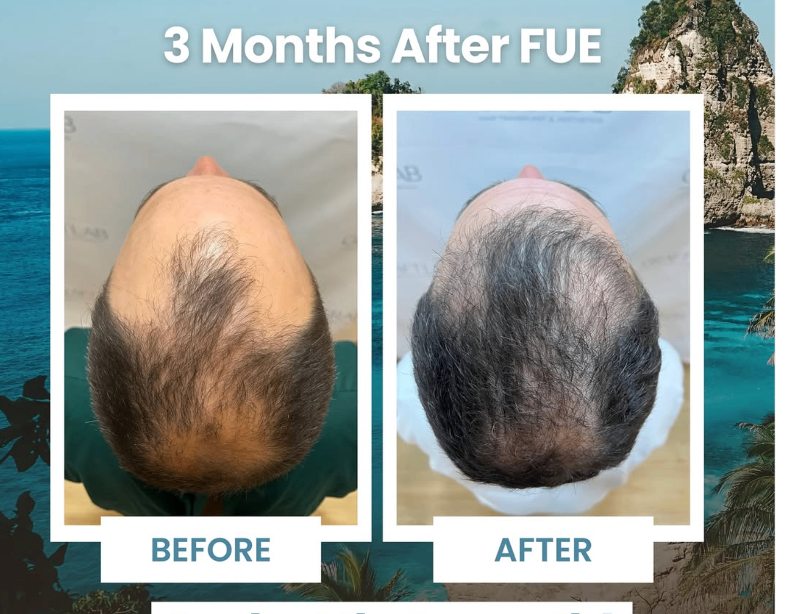 Three months after FUE showing before and after top density improvement
