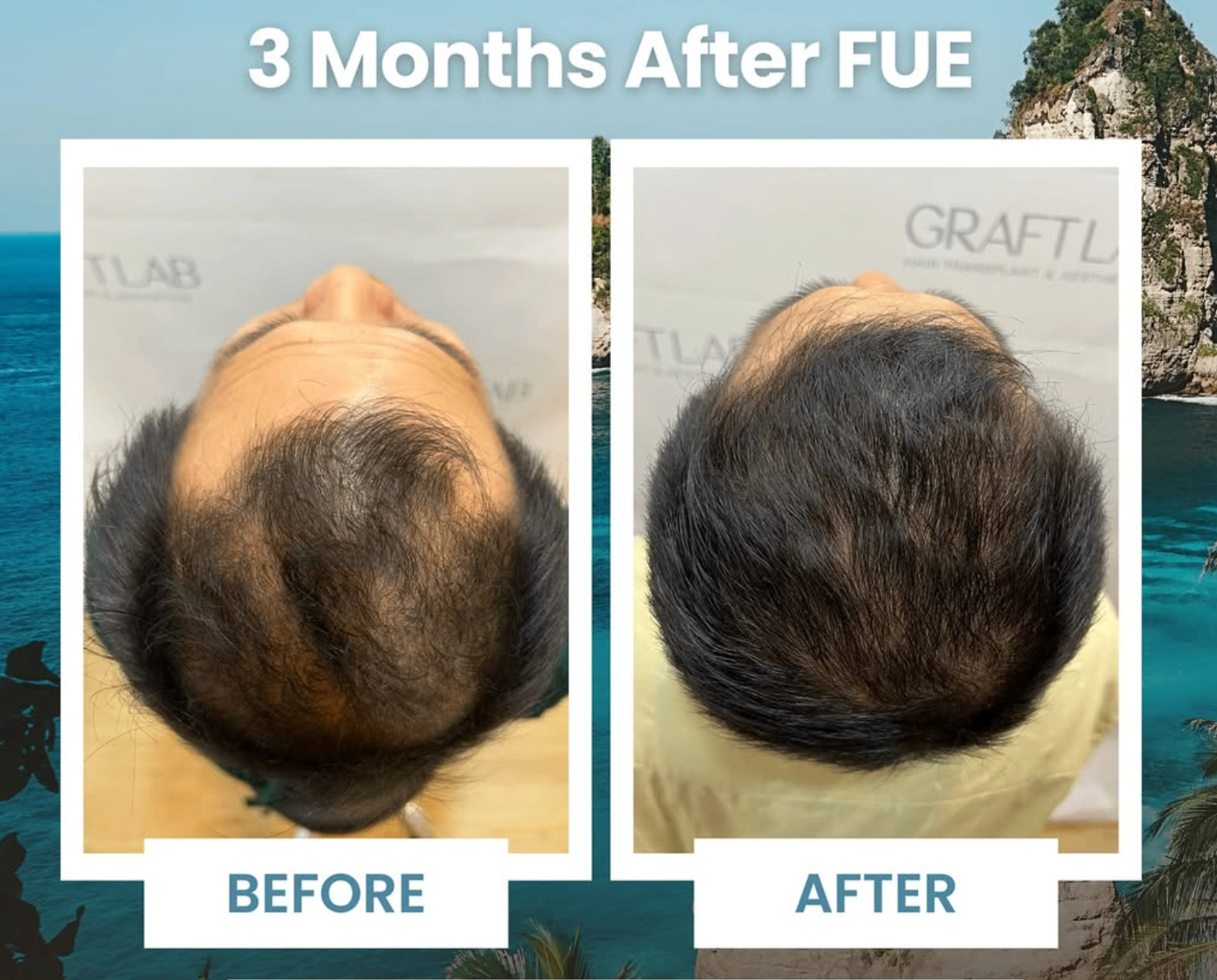 Three months after FUE showing before and after crown transplant