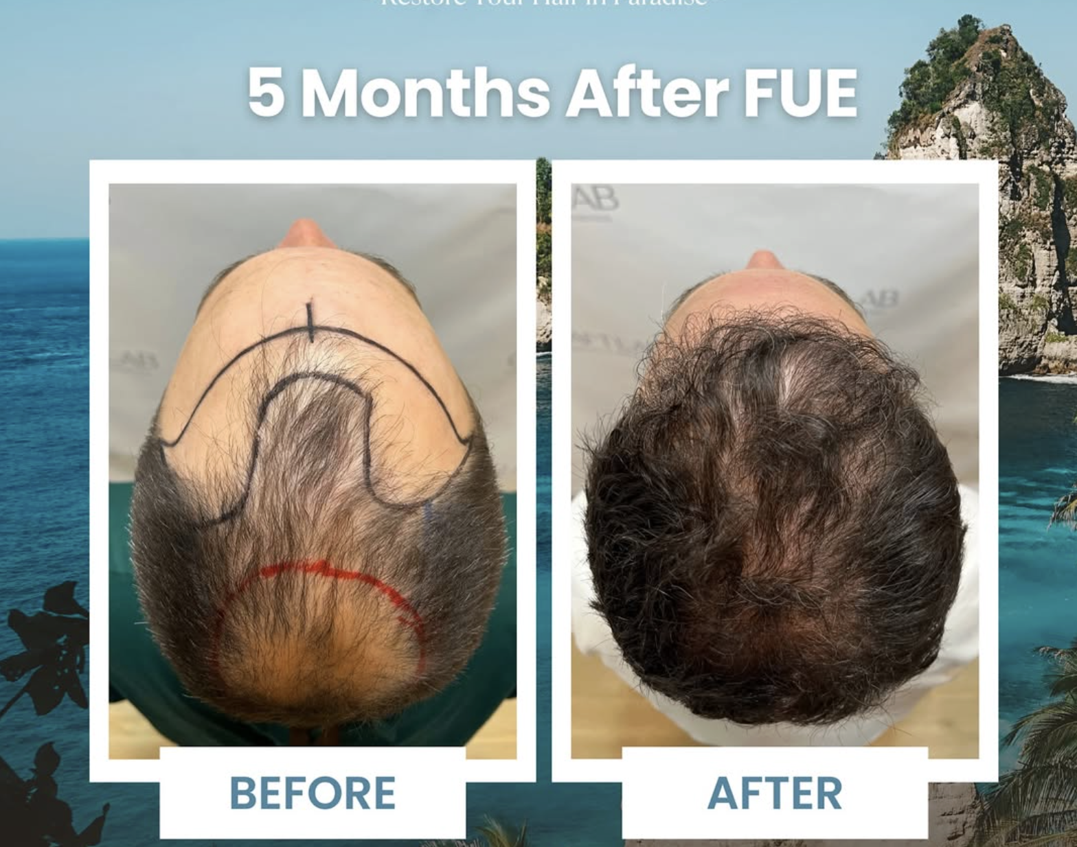 Five months after FUE showing before and after hair transplant