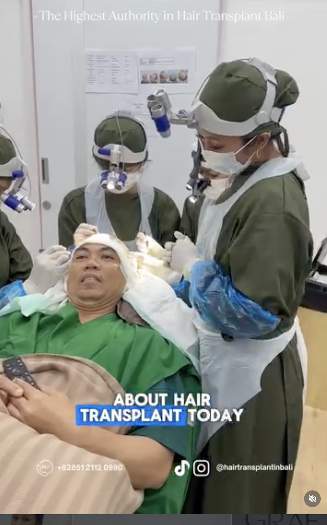 Hair transplant procedure in progress at Hair Transplant Bali